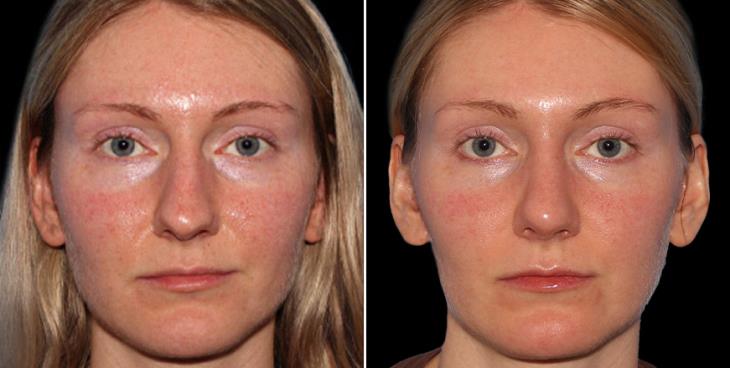 Results Of Scarless Nose Surgery In Atlanta GA